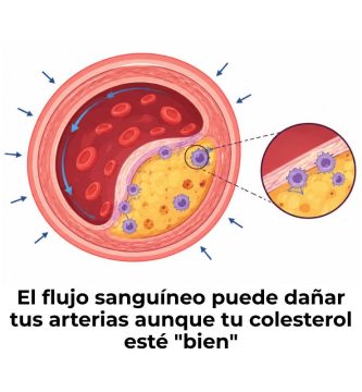 cómo afecta la biomecánica a la aterosclerosis
