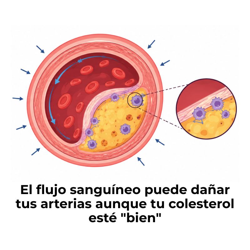 cómo afecta la biomecánica a la aterosclerosis